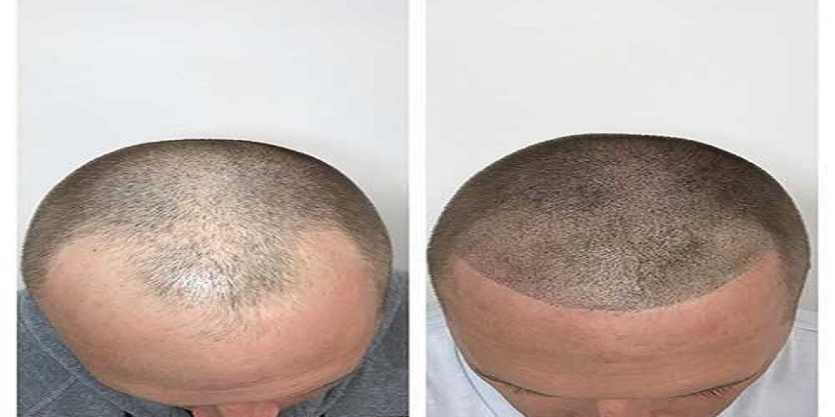 Hair Restoration 101: What to Expect from a Trichology Treatment