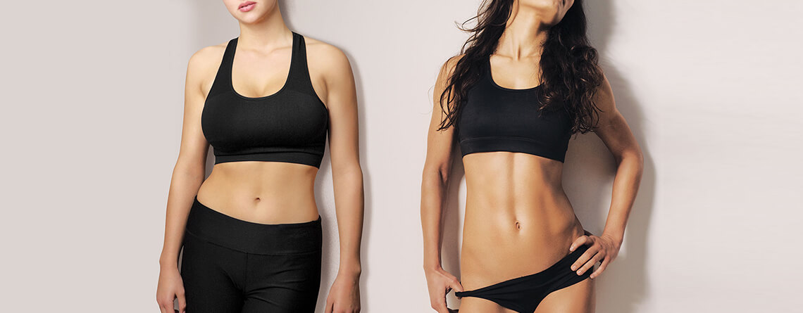 RG SHARP Technique for High-Definition Abdominoplasty