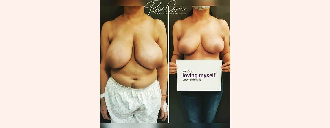 How Long Do Breast Lift Surgery Results Last? Dr Rajat Gupta