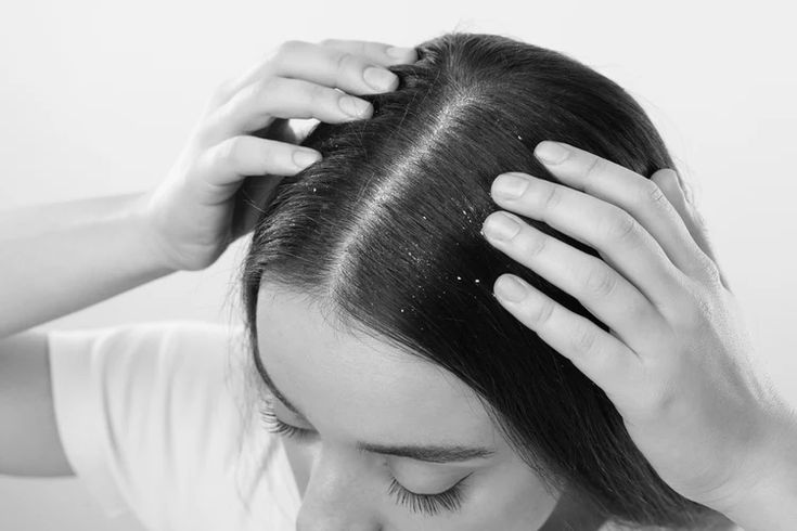 difference between dandruff and dry scalp