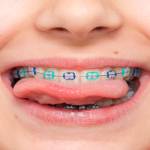 Dentist-Led Invisible Braces
